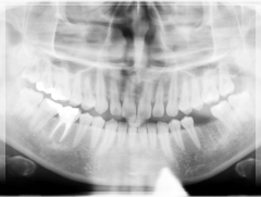 臼歯のインプラント治療